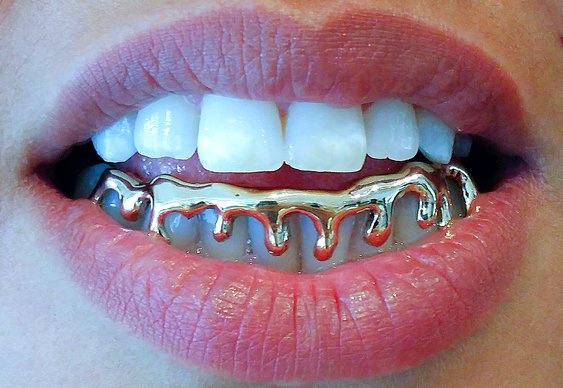Coroa dentaria de ouro